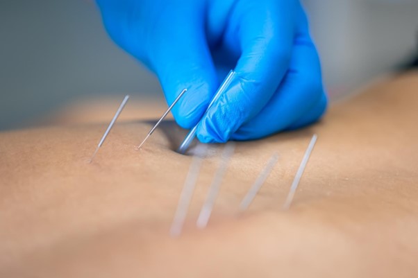 Dry Needling Ipswich Dry Needling Ipswich